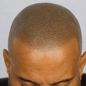 How to Care for Your Scalp Micropigmentation